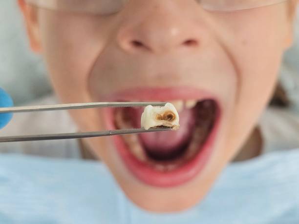 Best Emergency Dentist for Knocked-Out Tooth in Redlands, CA